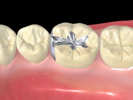 restorative-dentistry-best-dental-sealant-placement-clinic-in-banjarahills-hyderabad-vistadent