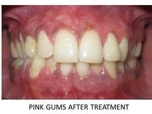 Pink gum treatment by vistadent hyderabad, Banjarahills