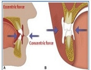 orthodotic-treatment-process-vistadent-best-clinic-in-hyderabad