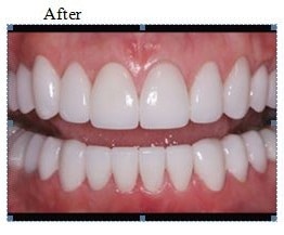 teeth-whitening-best-clinic-in-banjarahills-hyderabad-vistadent