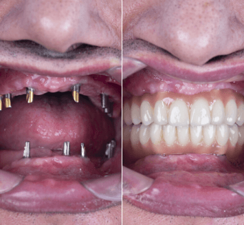 Prosthetic-Replacement-of-Teeth-Vistadent