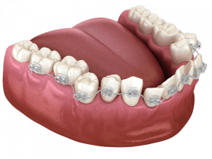 Dental fraces
