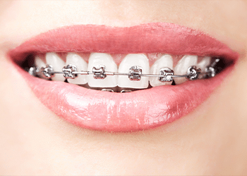 metal-braces