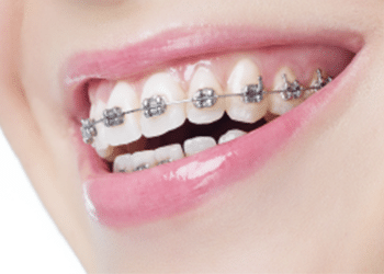 self-aligning-braces