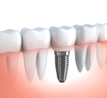 Dental-Implants-Vistadent