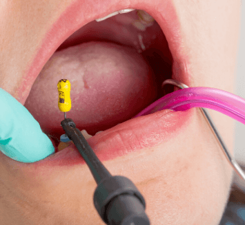 Endodontal-Treatment-Vistadent