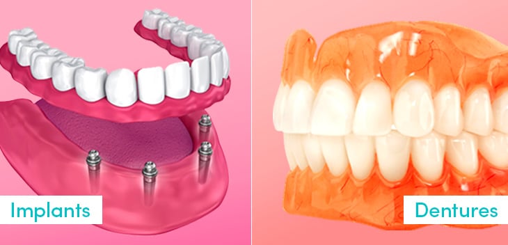 Dentures Vs Dental Implants Whats Right For You Vistadent 