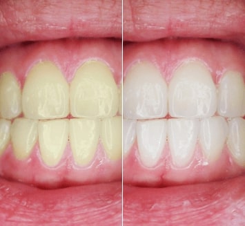Teeth-Whitening-At-Vistadent