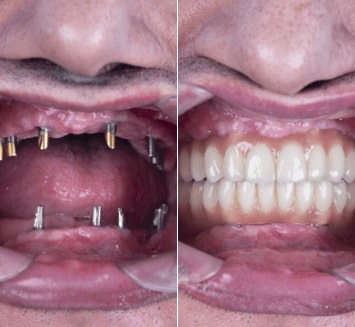 8.Prosthetic-Replacement-of-Teeth