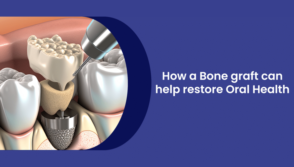 How a Bone graft can help restore Oral Health